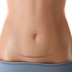 Abdominal Hysterectomy, scar is on lower abdomen below belly button
